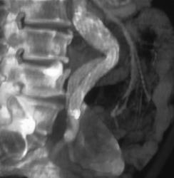 Kink in Endovascular Stent - CTisus CT Scan