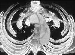 Aortic Dissection - CTisus CT Scan