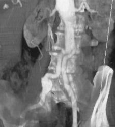 Iliac Artery Aneurysm - CTisus CT Scan