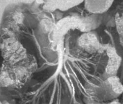 Atherosclerotic Changes of SMA - CTisus CT Scan