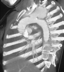 Aneurysm Off Aortic Arch - CTisus CT Scan