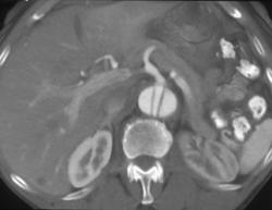 Aortic Dissection - CTisus CT Scan