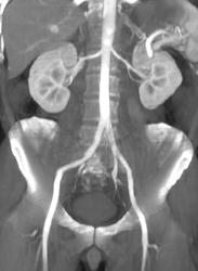 Normal Iliac Arteries - CTisus CT Scan