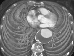 Aortic Aneurysm With Thrombus in the Wall - CTisus CT Scan