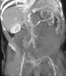 Retroperitoneal Sarcoma Displaces Left Renal Artery - CTisus CT Scan