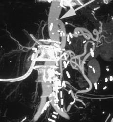 Graft and Collaterals to Celiac and IMA - CTisus CT Scan