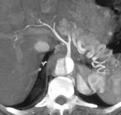 Aortic Dissection - CTisus CT Scan