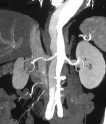 Aortic Dissection - CTisus CT Scan