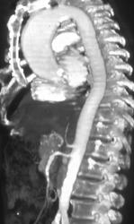 Dilated Ascending Aorta - CTisus CT Scan