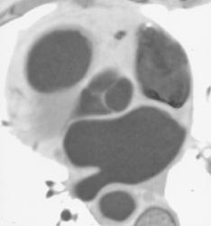 Aortic Valves - CTisus CT Scan