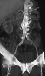 Kink in Meadox Stent - CTisus CT Scan