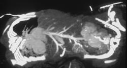 Ct Angiogram of Twins - CTisus CT Scan