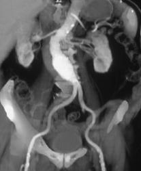 Aortic Aneurysm - CTisus CT Scan