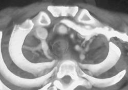 Takayasu's Arteritis - CTisus CT Scan