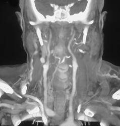 Jugular Vein Thrombosis - CTisus CT Scan