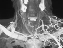 Jugular Vein Thrombosis With Collaterals - CTisus CT Scan