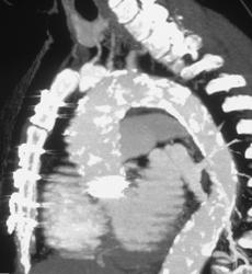 Calcified Aorta - CTisus CT Scan