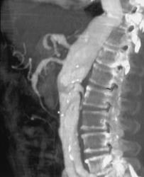 Celiac Artery Aneurysm - CTisus CT Scan