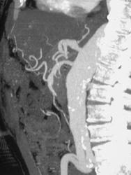 Aortic Dissection - CTisus CT Scan