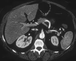 Dissection Extends Into Left Renal Artery and SMA - CTisus CT Scan