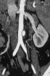 Pretty Dissection Extends Into Left Renal Artery - CTisus CT Scan