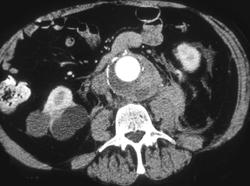 Aortic Aneurysm With Prior Leak - CTisus CT Scan