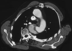 Aortic Dissection - CTisus CT Scan