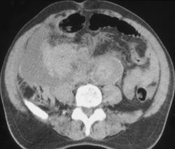 Retroperitoneal Bleed Due to Leaking Aneurysm - CTisus CT Scan