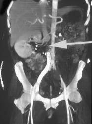 Retroperitoneal Fibrosis - CTisus CT Scan