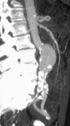 Aortic Aneurysm - CTisus CT Scan