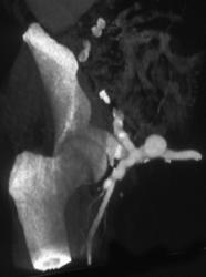 Pseudoaneurysm at Graft Site - CTisus CT Scan