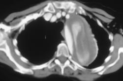 Aortic Dissection With True and False Lumens - CTisus CT Scan