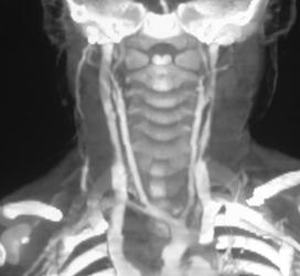 Carotid Stenosis - CTisus CT Scan