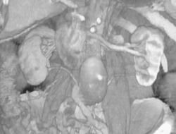 Aortic Aneurysm With Second Renal Artery Off Aneurysm - CTisus CT Scan