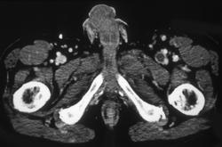 Left Deep Vein Thrombosis (DVT) - CTisus CT Scan