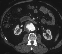 Aortic Aneurysm - CTisus CT Scan