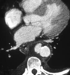 Aneurysm of Aorta - CTisus CT Scan