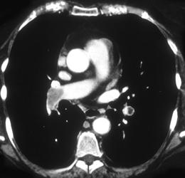 Pulmonary Embolism - CTisus CT Scan