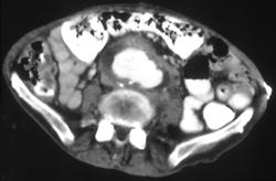 Aortic Aneurysm - CTisus CT Scan