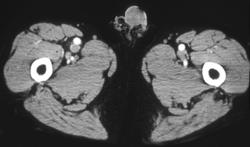 Deep Venous Thrombosis on the Right - CTisus CT Scan