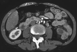 Occluded Aorta With Collaterals - CTisus CT Scan