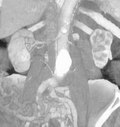 Aortic Aneurysm - CTisus CT Scan