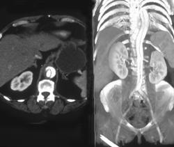 Aortic Dissection - CTisus CT Scan