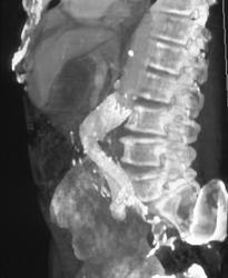 Bending of Stent Graft - CTisus CT Scan