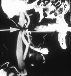 Carotid Artery Study With Artifact - CTisus CT Scan