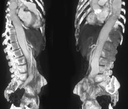 Aortic Dissection - CTisus CT Scan