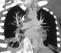 Pulmonary Embolism - CTisus CT Scan