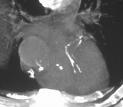 Coronary Artery Calcification - CTisus CT Scan