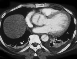 Aortic Dissection - CTisus CT Scan