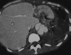 Aortic Dissection - CTisus CT Scan